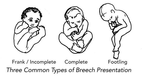 how many types of breech presentation